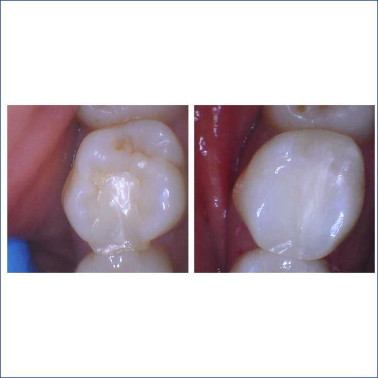 CLEIVIS-BEFORE-AFTER-BIOCLEAR-RESTORATION