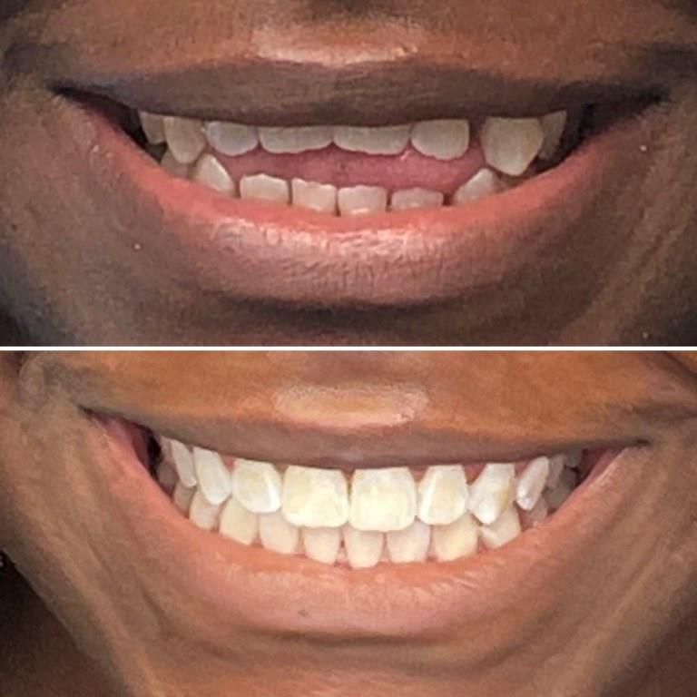 BEFORE AND AFTER INVISALIGN