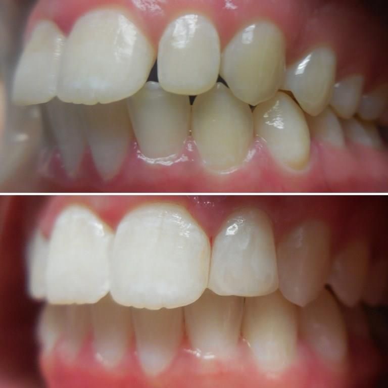 SANDRA BEFORE AFTER INVISALIGN