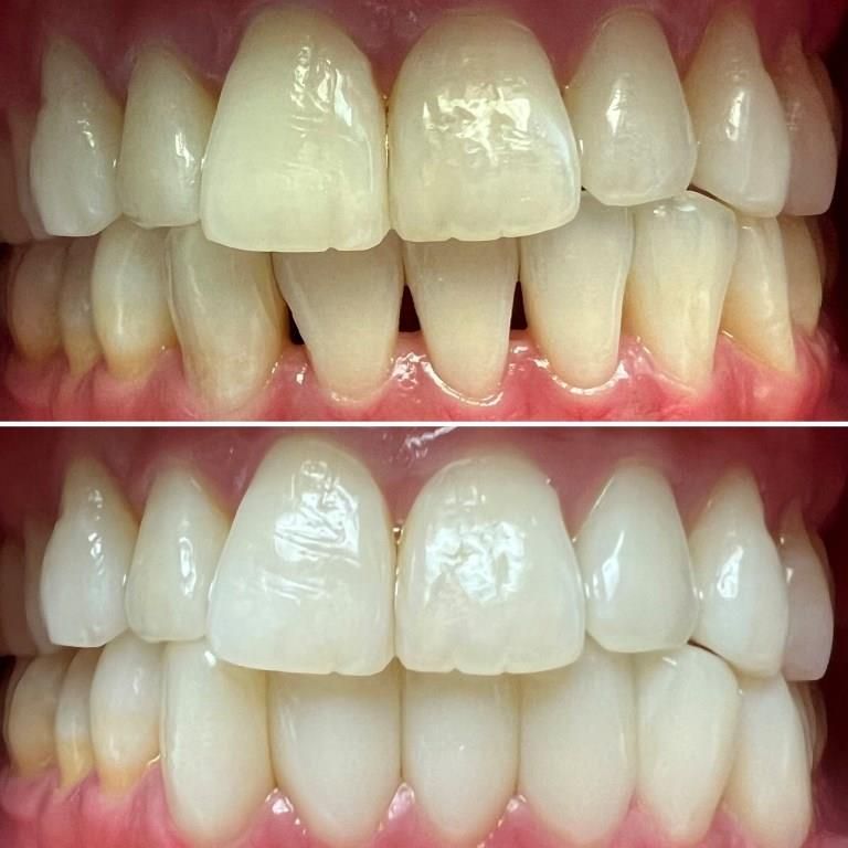 MAI BEFORE AFTER BLACK TRIANGLE TREATMENT + ROOT OVERLAY