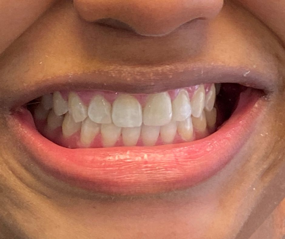 AfterInvisalign Treatment 