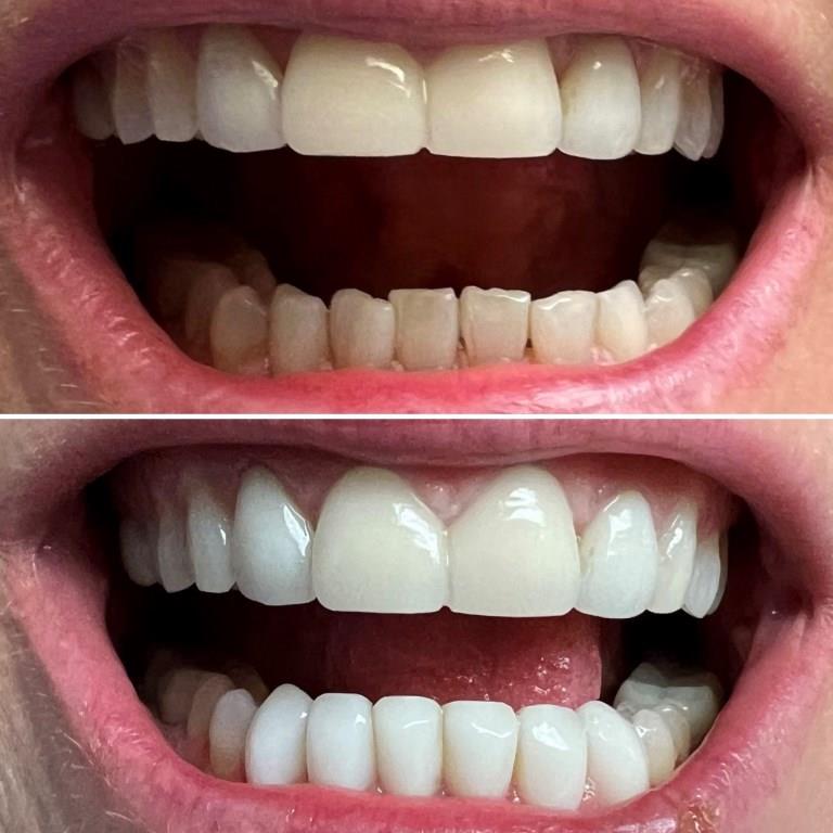 ALLISON BEFORE AFTER 360 VENEER OVERLAY