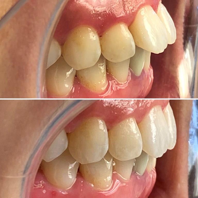 CHAN BEFORE AFTER INVISALIGN