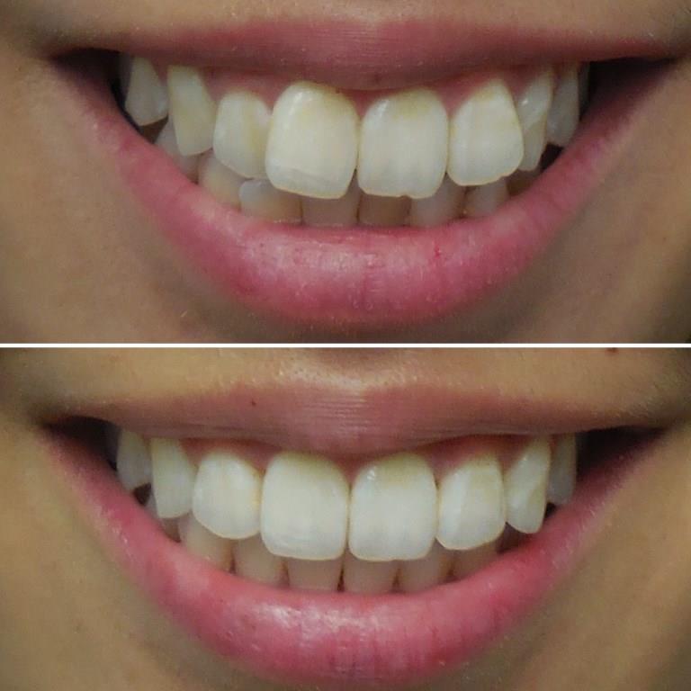 CHOI BEFORE AFTER INVISALIGN