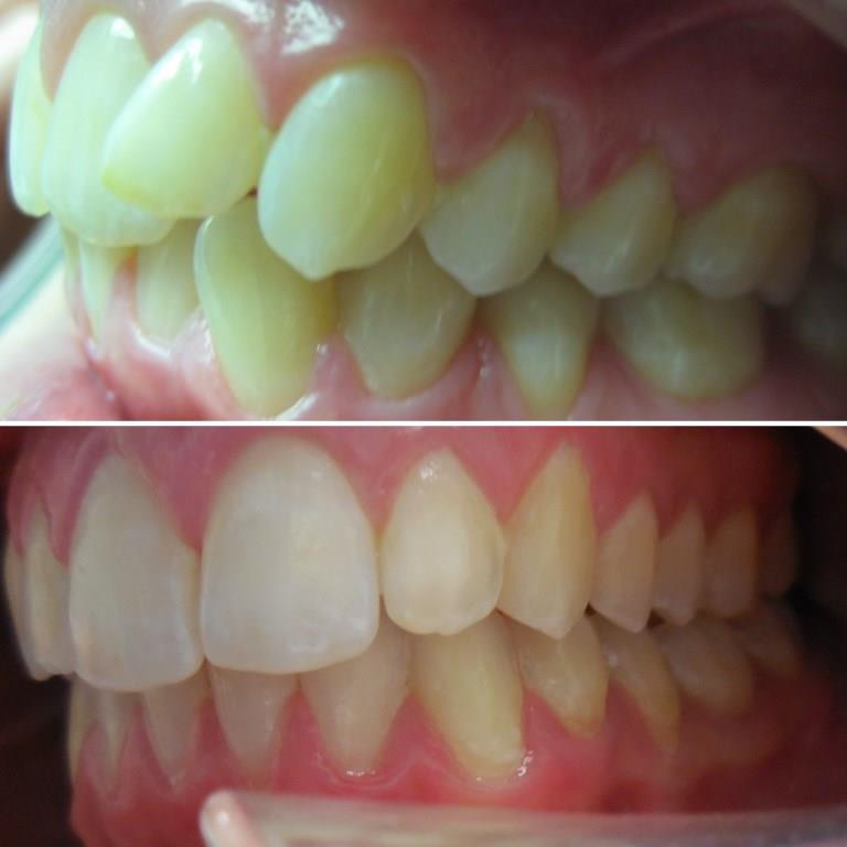 ELIZABETH BEFORE AFTER INVISALIGN