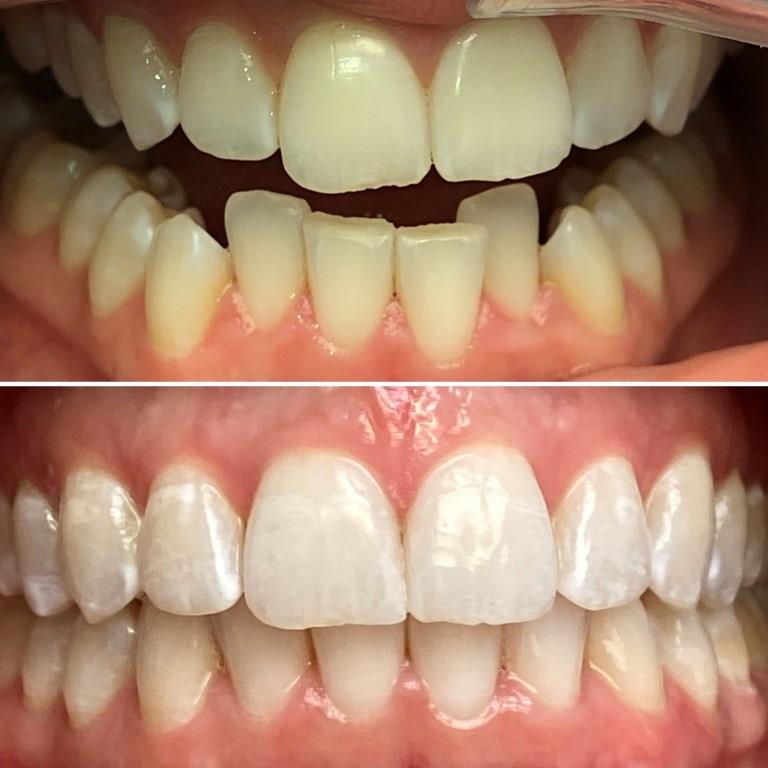 EMILY BEFORE AFTER INVISALIGN