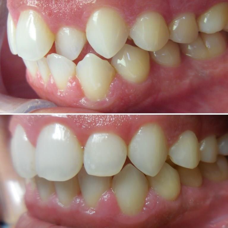 EUGENE BEFORE AFTER INVISALIGN 2