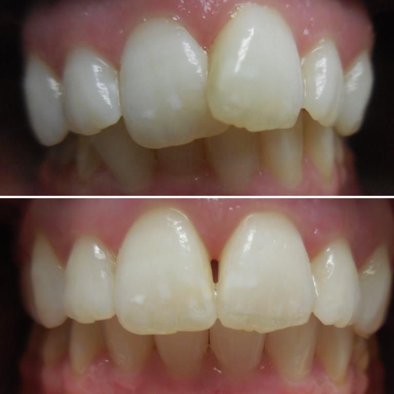 KATE BEFORE AFTER INVISALIGN 2