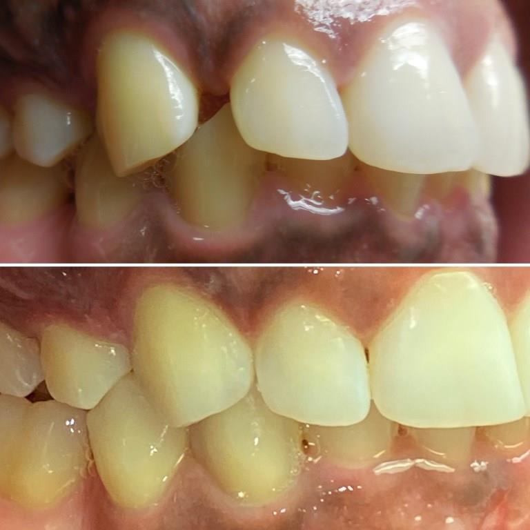 MARVIN BEFORE AFTER INVISALIGN 2