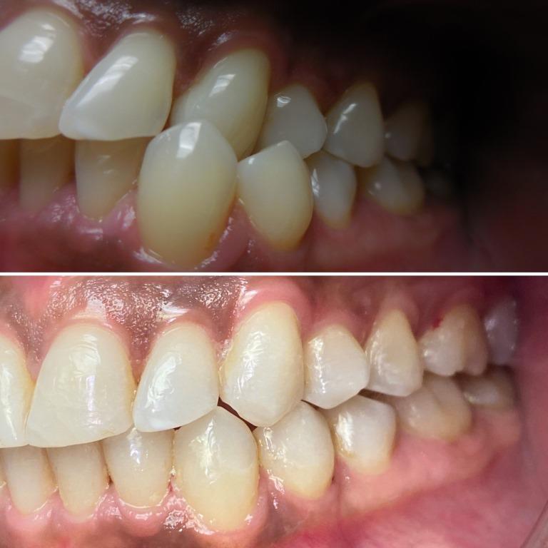 NATASHA BEFORE AFTER 2 INVISALIGN