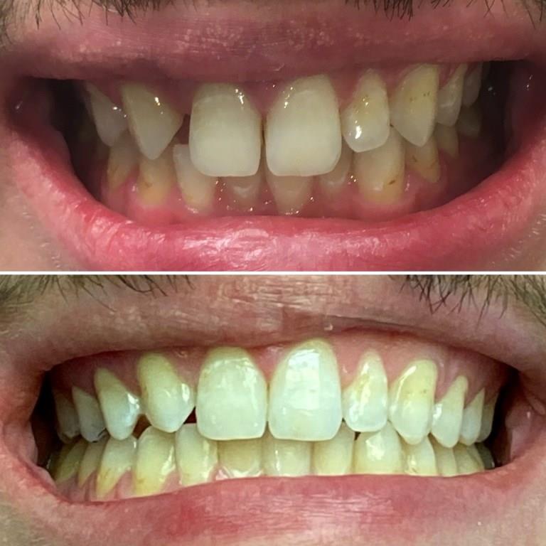 NICHOLAS BEFORE AFTER INVISALIGN