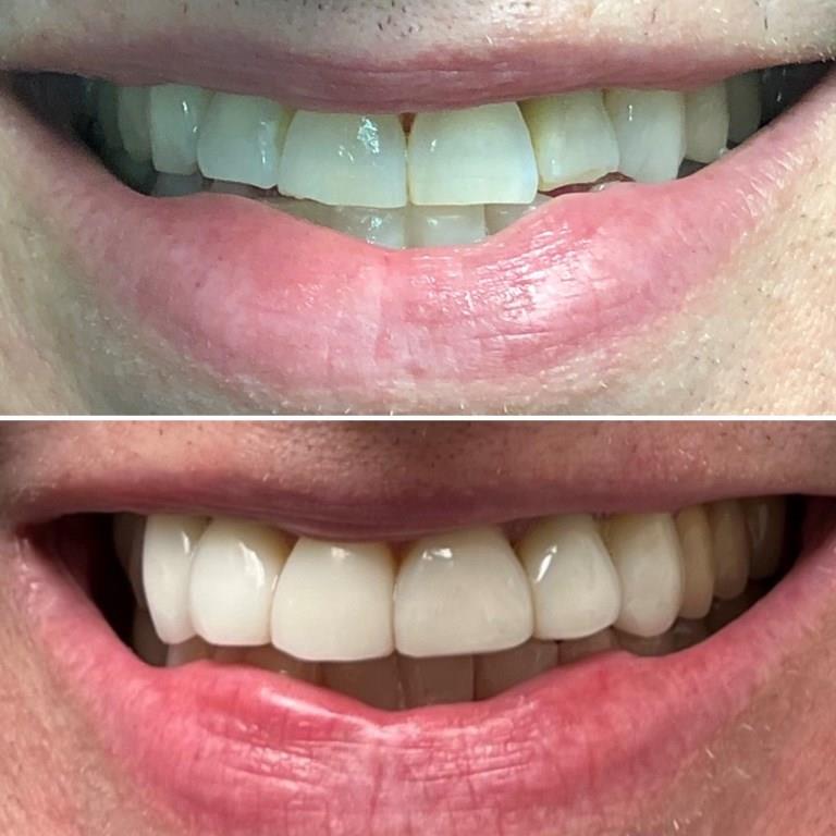 RANDY BEFORE AFTER VENEER OVERLAY + ROOT OVERLAY