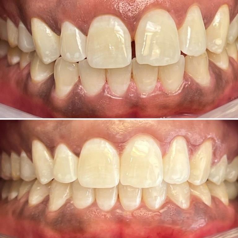 TAMEKA BEFORE AFTER INVISALIGN