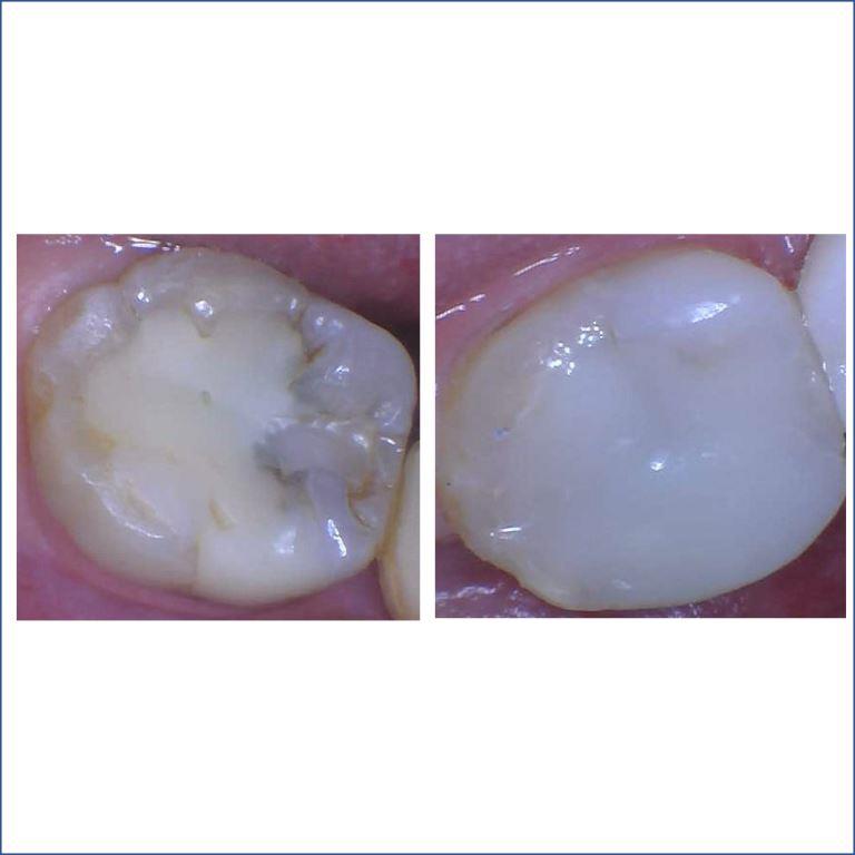 1STELLA-BEFORE-AFTER-OVERLAY