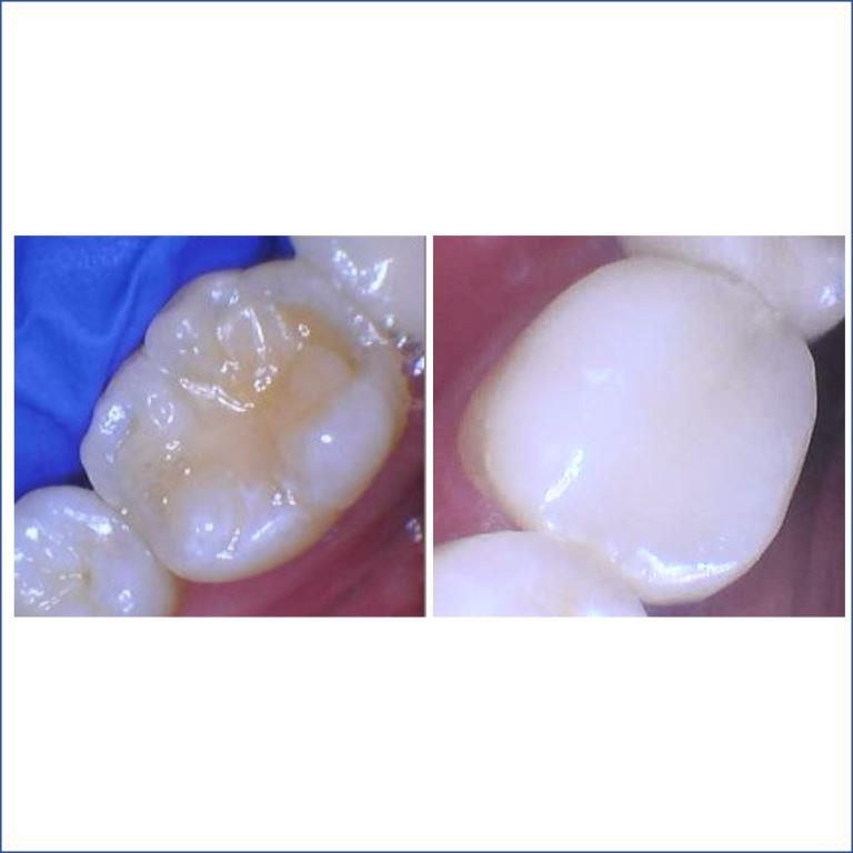 2JULIANNA-BEFORE-AFTER-OVERLAY