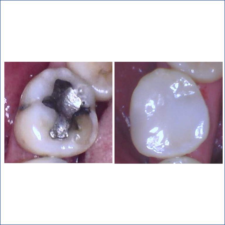3TAM-BEFORE-AFTER-POSTERIOR-RESTORATION-1