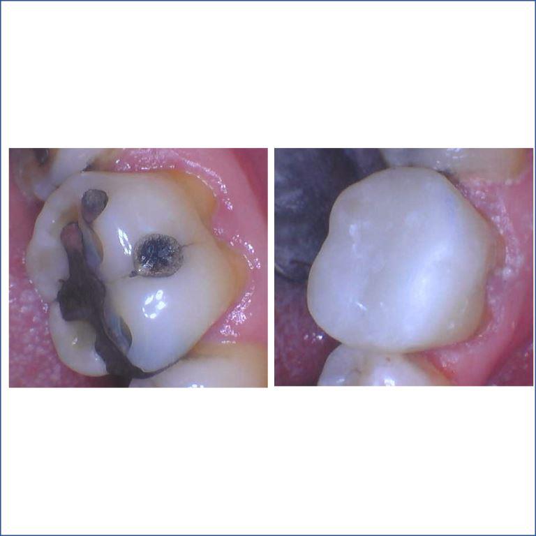 4TAM-BEFORE-AFTER-POSTERIOR-RESTORATION-2