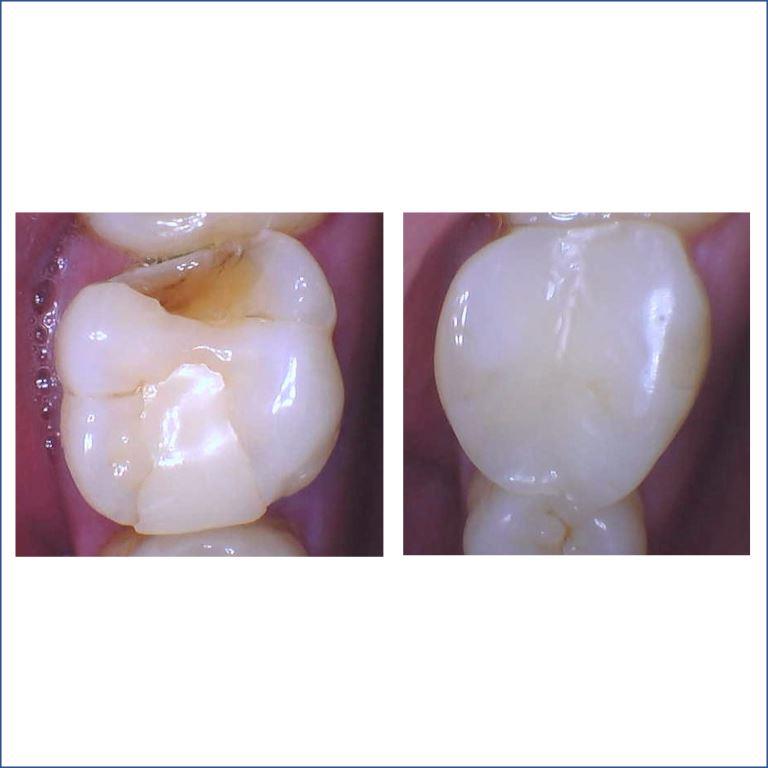 RUBEN-BEFORE-AFTER-WORN-BROKEN-TEETH