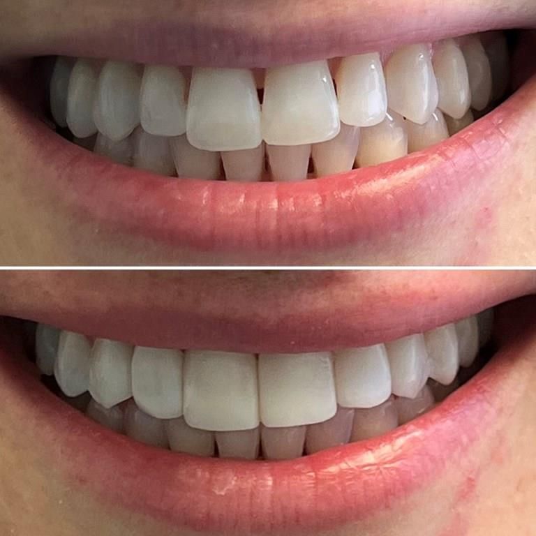 LAUREN BEFORE AFTER BLACK TRIANGLE