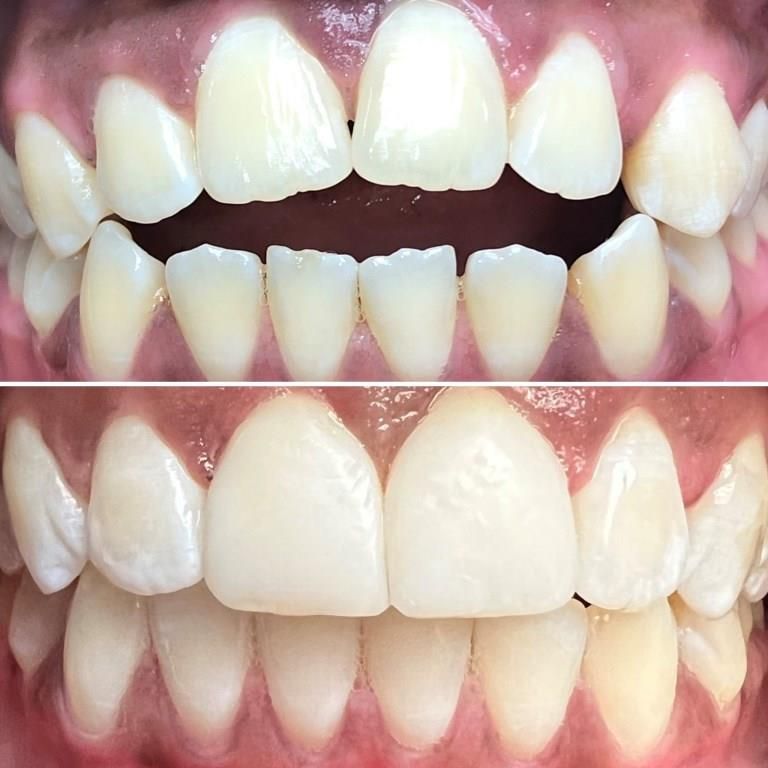 KATHYLEE BEFORE AFTER 2 BLACK TRIANGLE