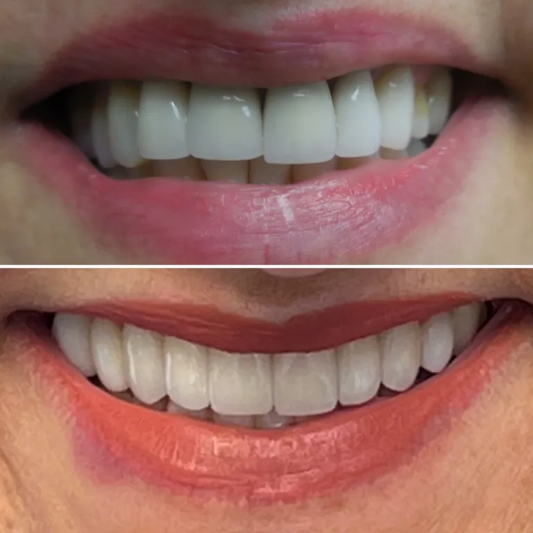 WEBSITE BEFORE AFTER VENEERS 