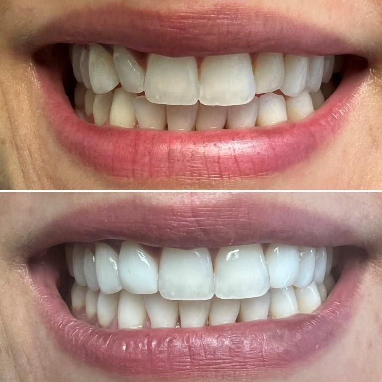ANOO BEFORE AFTER 360 VENEER OVERLAY